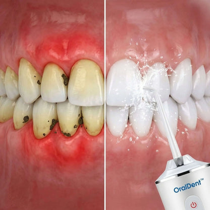Irrigador dental OralDent™: Adiós Encías Inflamadas y Mal Aliento (Más Eficaz que el Cepillado y el Hilo Dental)